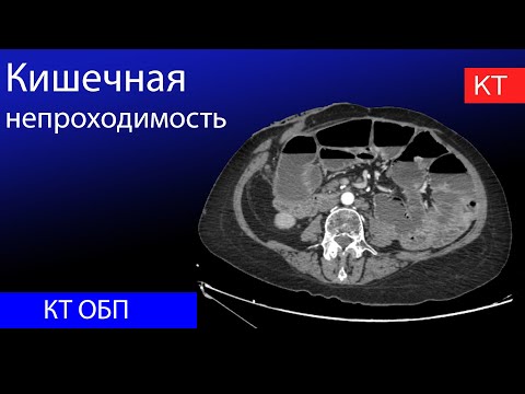 Видео: Кишечная непроходимость на КТ