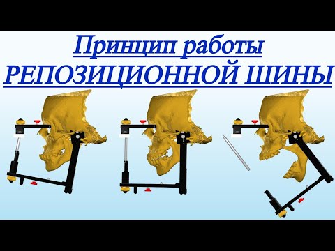 Видео: ВЫВИХ ДИСКА ВНЧС, ОРТОТИК, СПЛИНТ, РЕПОЗИЦИОННАЯ ШИНА