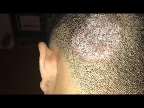 Видео: Микозы кожи (доклад проф. Самцова А.В.)