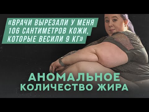 Видео: У меня аномальное количество жира | Хочу спросить