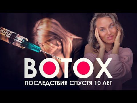 Видео: БОТОКС. 10 лет. Последствия. Опыт. Вся правда. Гимнастика делала хуже?
