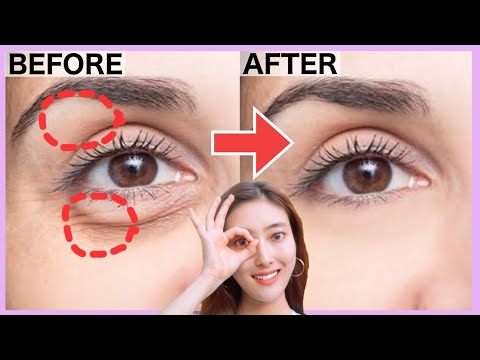 Видео: Как устранить провисание под глазами, мишки под глазами, морщины