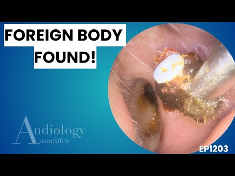 Видео: Сборник экстремального удаления ушной серы | Инородные тела и закупорка кожи - EP1203