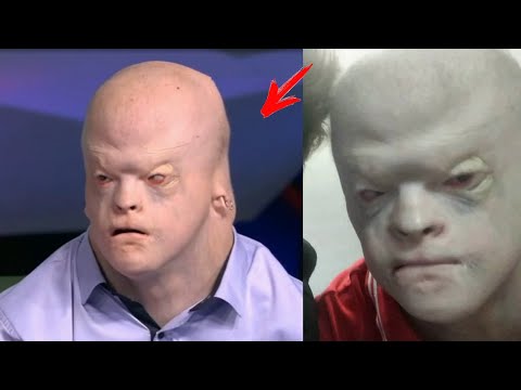 Видео: В мире всего 16 таких ЛЮДЕЙ! Как живет парень с внешностью ГУМАНОИДА от которого отказалась МАТЬ?