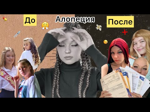 Видео: Облысела в 12 лет || моя "лысая" история || #алопеция #выпадениеволос #облысение | Lisaya Blondinka
