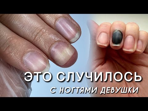 Видео: УДАЛЯТЬ ИЛИ СПАСАТЬ? Ноготь на руке скрутился и сдавил фалангу пальца ☹️