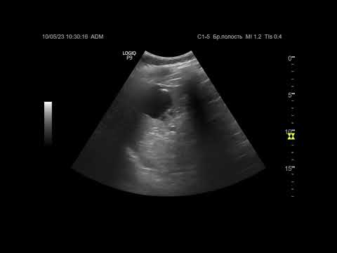 Видео: Ультразвуковая диагностика. Доктор Иогансен. Видеопримеры. Выпуск 74. Кисты селезенки.