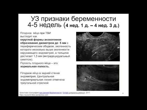 Видео: Ультразвуковые признаки беременности 4-5  недель2022 05 03 14 04 09