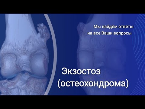 Видео: Экзостоз