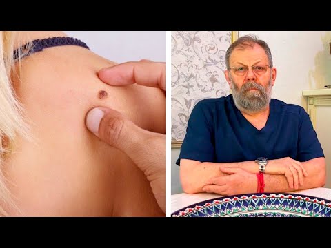 Видео: Кератомы. Как лечить?