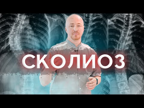 Видео: Как определить:  сколиоз или сколиотическая осанка? Почему даже врачи ошибаются?