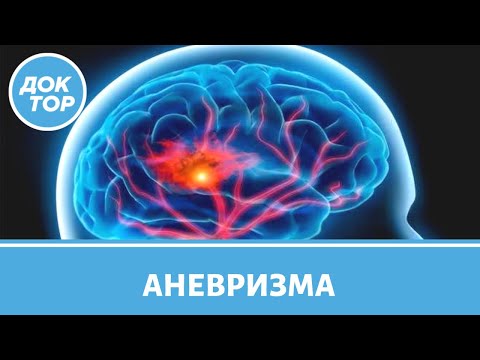 Видео: Аневризма сосудов головного мозга: кто в группе риска?