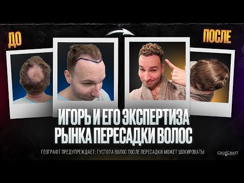 Видео: Игорь и его экспертиза рынка пересадки волос. Выбор Игоря - ГеоГрафт