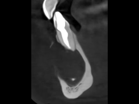 Видео: Киста нижней челюсти. Удаление зуба. Киста зуба как лечить. Периодонтит. Гранулёма. Имплантация зуба