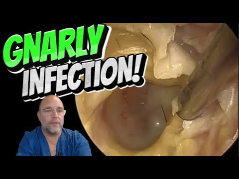 Видео: ГРЯЗНАЯ ИНФЕКЦИЯ! 346 #ухо #ушнаясера #удалениеушнойсеры #ушнаясера #удовлетворение #длявас #fyp ...