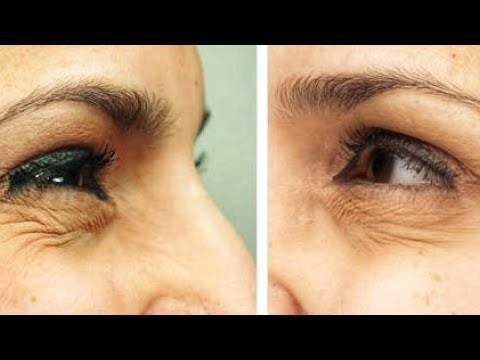 Видео: #2. Морщины вокруг глаз. Упражнения от морщин вокруг глаз.