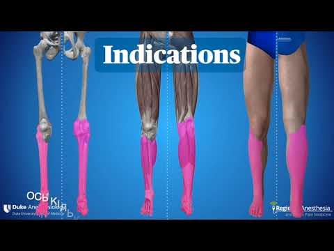 Видео: Блокада  сідничного нерва підколінним доступом