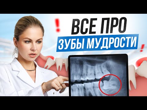 Видео: Зубы мудрости: зачем нужны, когда удалять и какие могут быть осложнения