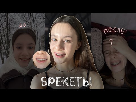 Видео: влог: мне поставили брекеты ✨