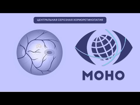 Видео: ЦСХ - что это такое? Методы диагностики и лечения центральной серозной хориоретинопатии (ЦСХРП)