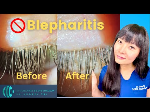 Видео: Лучшие методы лечения блефарита в домашних условиях | Простое и эффективное | Пошаговое руководст...