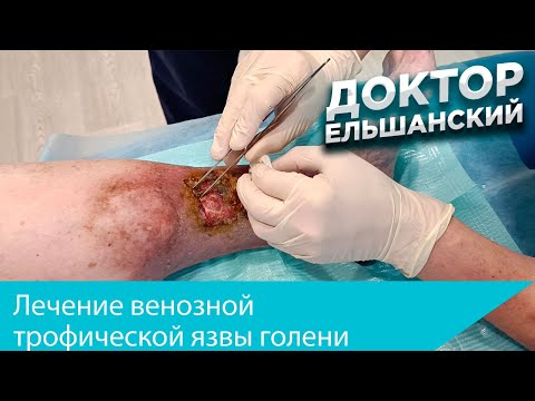 Видео: Лечение венозной трофической язвы (Venous ulcer treatment)