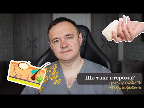 Видео: Атерома. Як її лікувати? Чи є атерома раком?