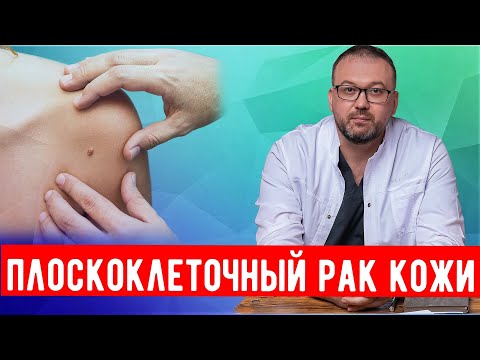 Видео: Плоскоклеточный рак кожи, что это и как лечить.