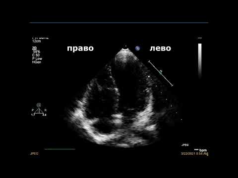 Видео: Протокол ЭхоКГ у детей, четырехкамерная позиция (рус.)