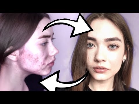 Видео: КАК Я ИЗБАВИЛАСЬ ОТ ПРЫЩЕЙ (И СЛЕДОВ ОТ НИХ) //  МОЯ ИСТОРИЯ