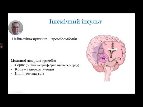 Видео: Модуль 1. Загальні поняття про інсульт.