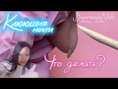 Видео: Клюющие ногти.Поднятие клюющих ногтей полигелем