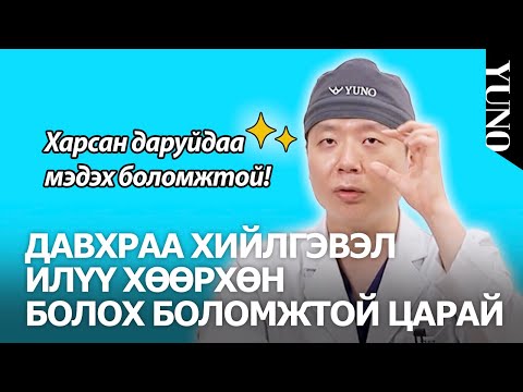 Видео: Давхраа хийлгэвэл үнэхээр сайн болох нүд тусдаа байна гэж үү? Юүну гоо сайхны эмнэлгэт