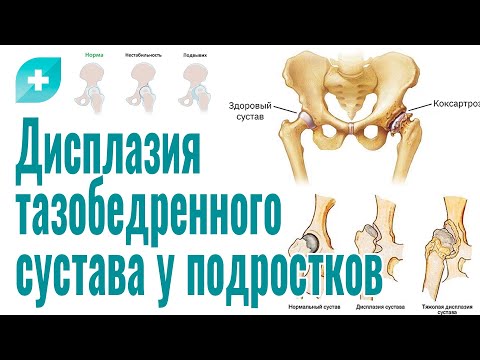 Видео: Дисплазия тазобедренного сустава у подростков