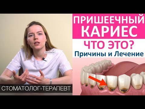 Видео: Пришеечный кариес - виды, причины, лечение, профилактика