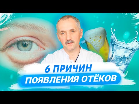 Видео: Почему появляются отёки? Основные причины, диагностика, рекомендации / Доктор Виктор