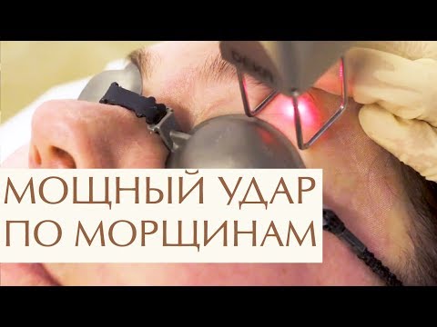Видео: 💆  Что такое лазерное омоложение лица, этапы процедуры. Лазерное омоложение лица что это. 12+