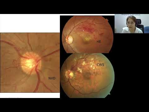 Видео: Илтгэл: Торлогийн венийн судасны бөглөрөл