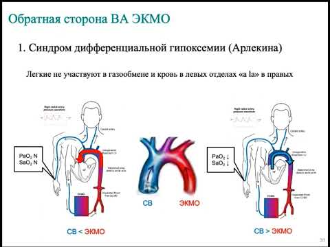 Видео: ВА ЭКМО при шоке и СЛР Кецкало М.В.