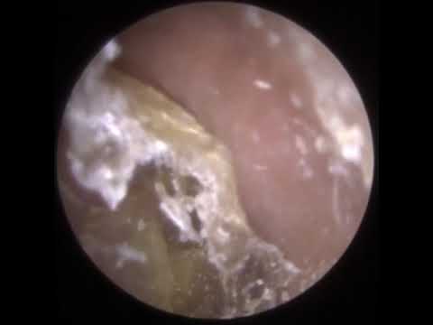 Видео: 790 - Отшелушивание инфицированной омертвевшей кожи