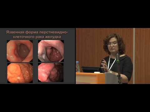Видео: Эндоскопическая диагностика гастритоподобных форм лимфом и перстневидно-клеточного рака желудка