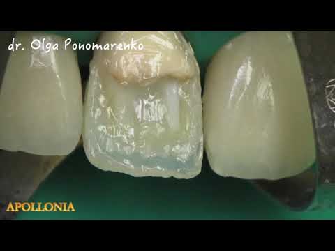 Видео: Реставрация фронтального ансамбля зубов, армирование стекловолокном