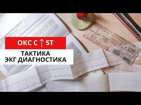 Видео: Инфаркт миокарда с подъемом сегмента ST.  ЭКГ диагностика. Тактика. Часть 2.