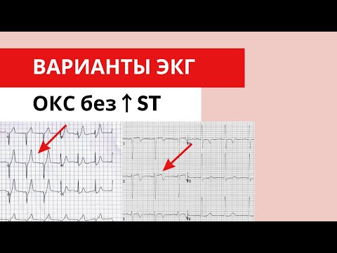 Видео: Варианты ЭКГ ОКС без подъема сегмента ST.