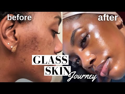 Видео: КАК Я ИЗБАВИЛАСЬ ОТ ГИПЕРПИГМЕНТАЦИИ, АКНЕ И ТЕМНЫХ ПЯТЕН!! | ПРОЦЕДУРА GLASS SKIN *ОБЯЗАТЕЛЬНО К...