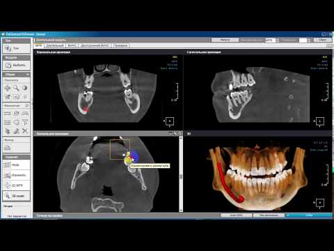 Видео: Обзор программы Ondemand3d Dental