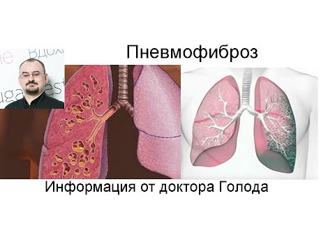 Видео: Как лечить пневмофиброз - фиброз лёгких?