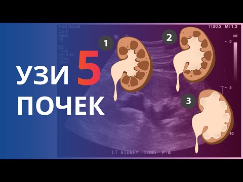 Видео: УЗИ почек. Часть 5. Степени Гидронефроза и его дифференциаьная диагностика