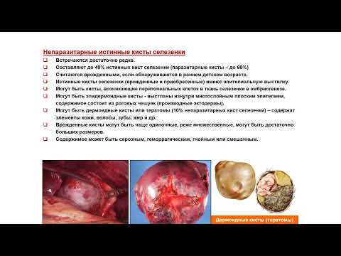 Видео: УЗИ. Доктор Иогансен. Выпуск 63. Неопухолевые очаговые изменения селезенки. Часть 1.