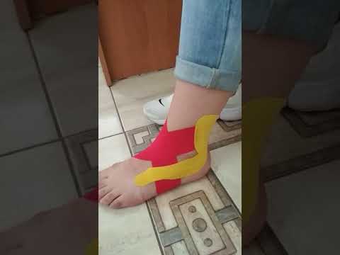 Видео: Тейпування при пошкодженні зв'язок гомілково ступневого суглобу.